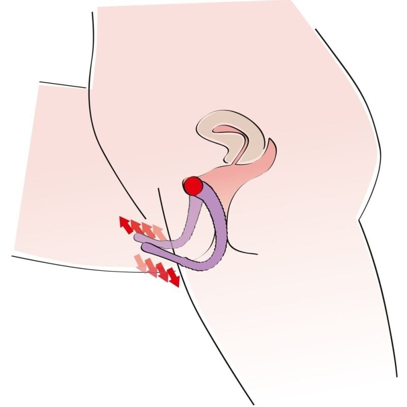 Intymus plėtiklis